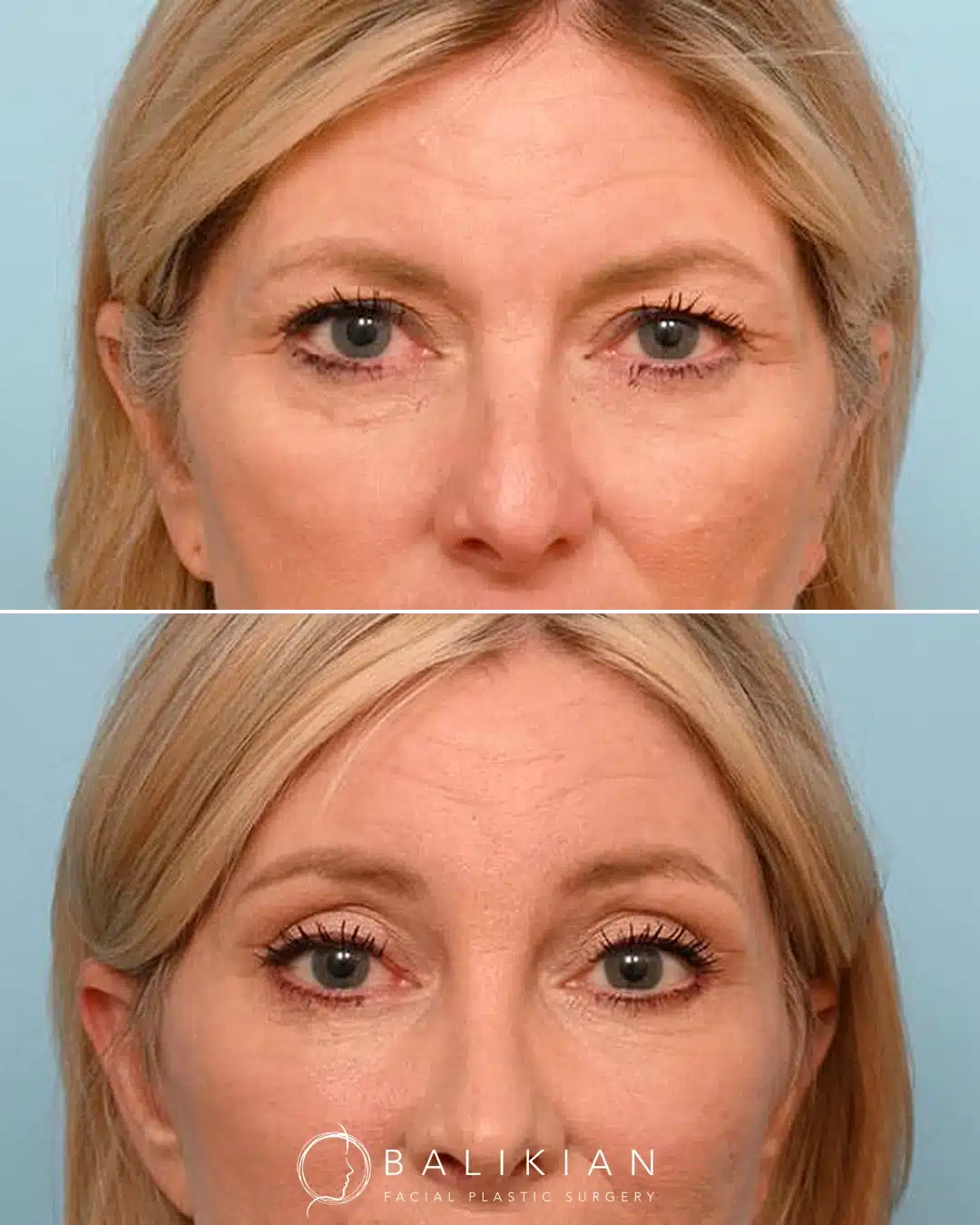 Frontal before and after upper blepharoplasty with lower eyelid skin pinch showing improved upper eyelid openness and reduced under-eye wrinkling.