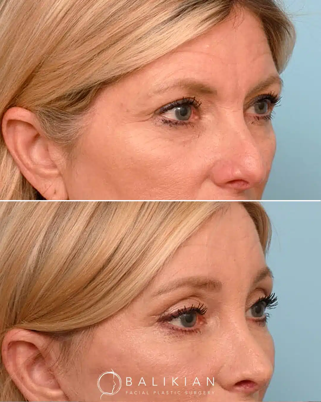 Angled before and after of upper blepharoplasty with lower eyelid skin pinch showing smoother under-eye lines, lifted upper eyelids, and enhanced periorbital definition.