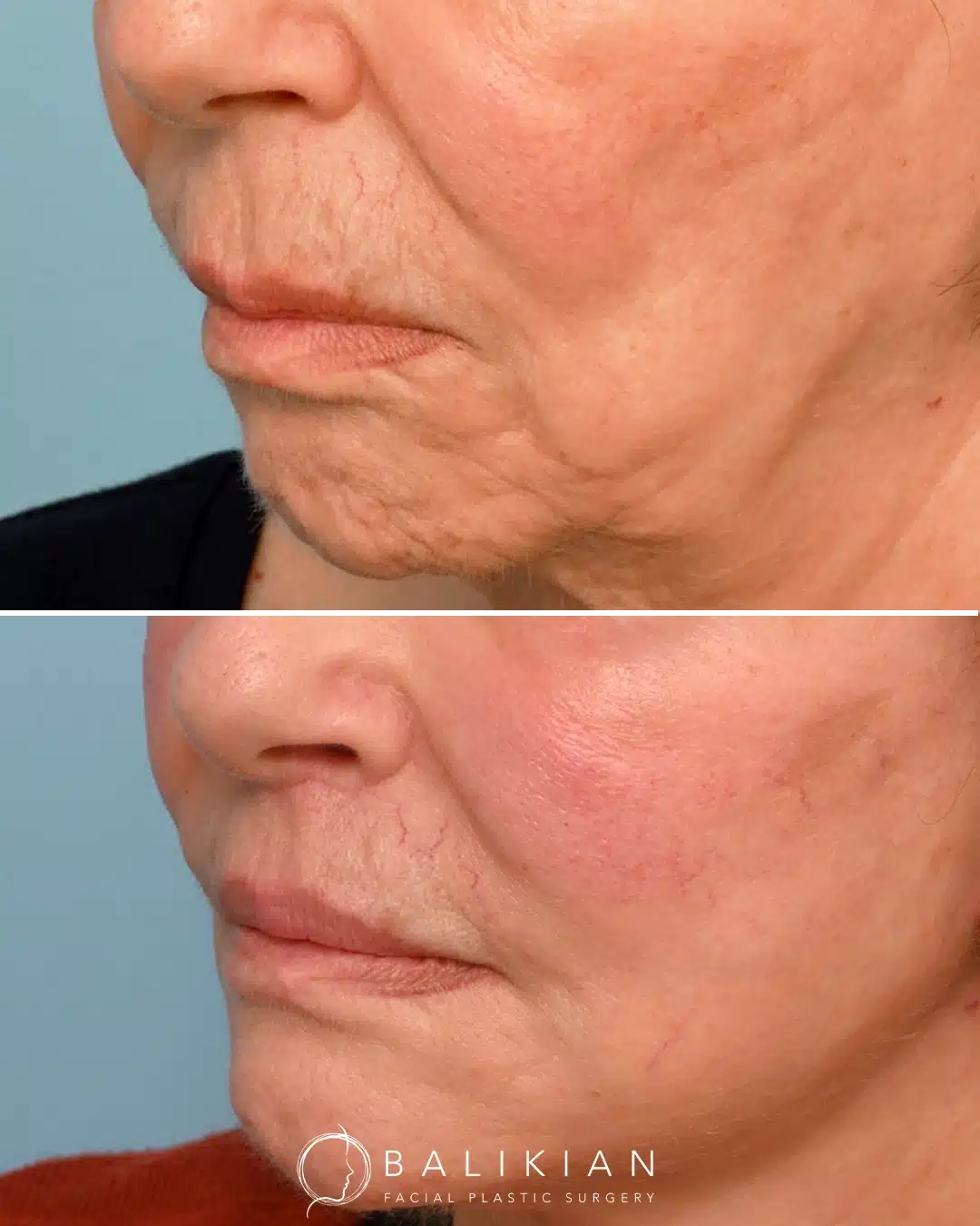 Before and after oblique view showing reduced vertical lip length, smoother upper lip wrinkles, and improved lip support following a surgical lip lift.