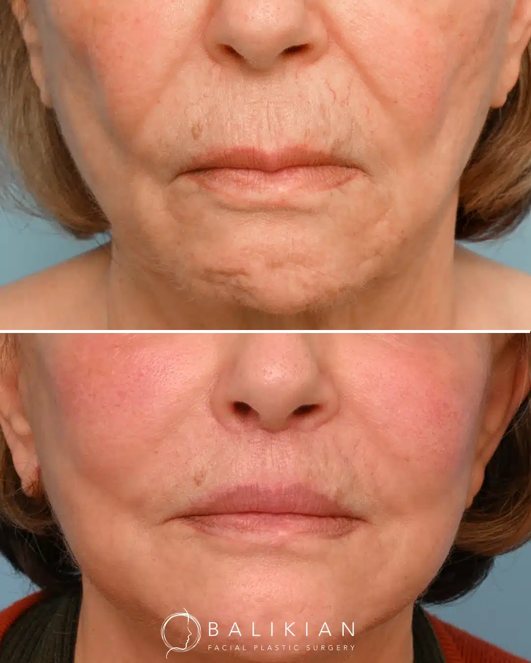 Before and after front view showing a shorter upper lip, smoother skin around the mouth, and enhanced lip definition after a surgical lip lift.