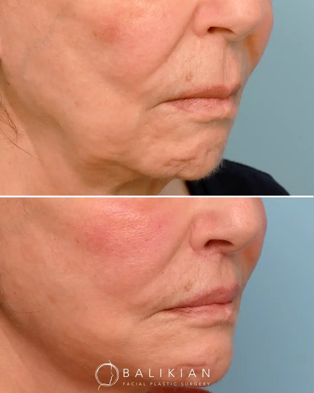 Before and after oblique view highlighting a lifted upper lip, softened perioral lines, and improved lip contour after a subnasal lip lift.