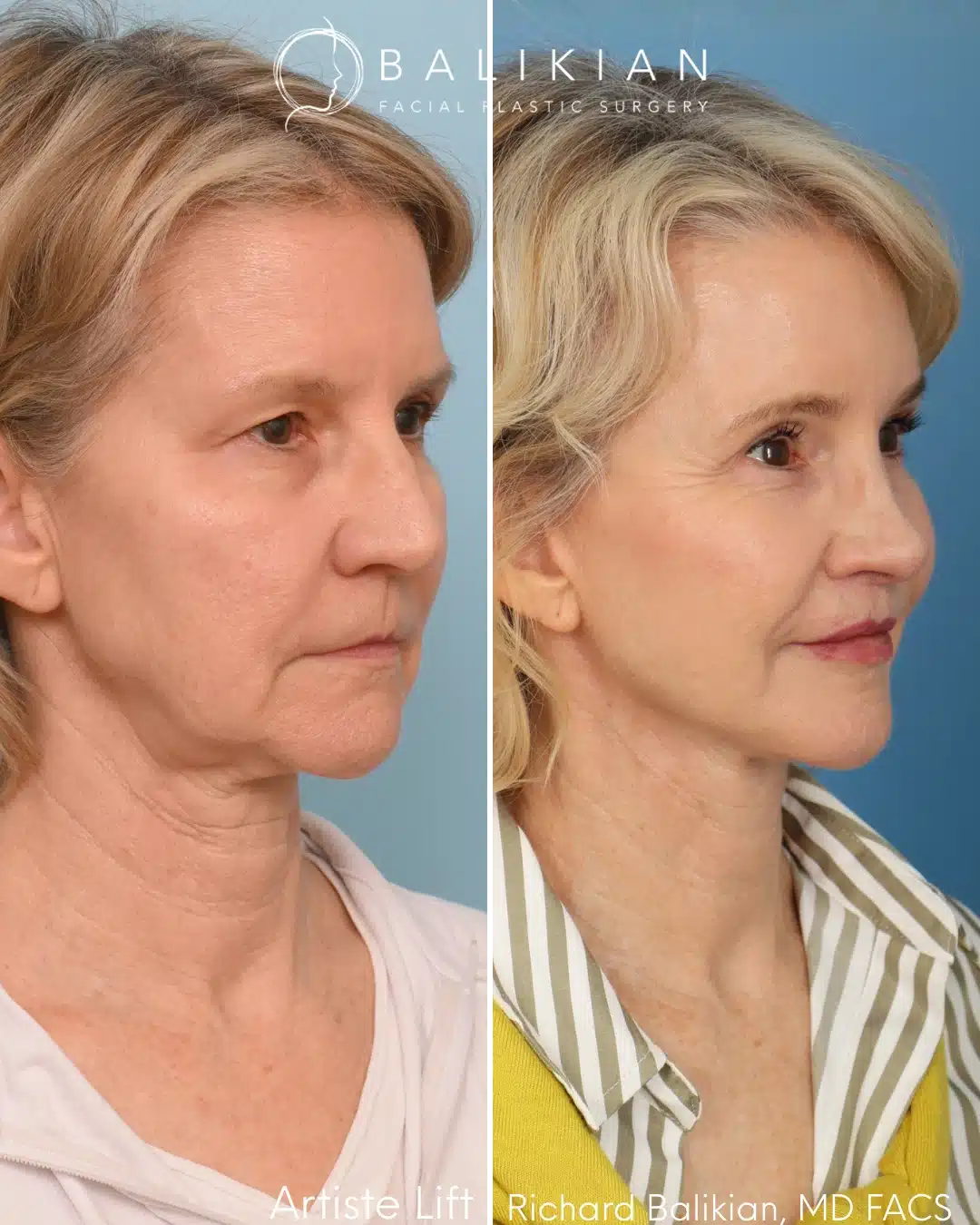 Before and after deep plane facelift demonstrating significant tightening of the neck, improved jawline sculpting, and enhanced cheek support for a youthful profile.