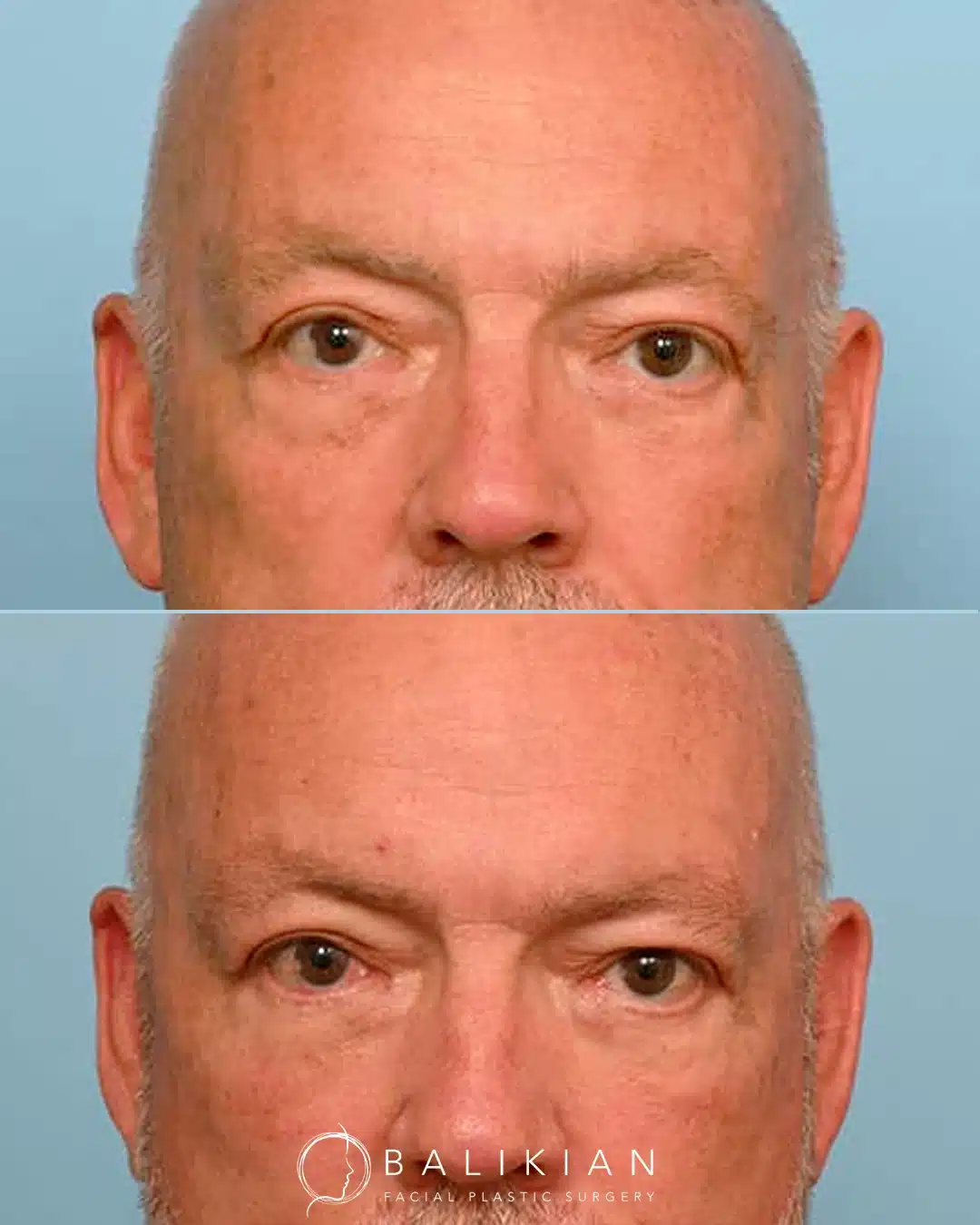 Before and after lower eyelid surgery in a male patient showing smoother under-eye area and improved definition.