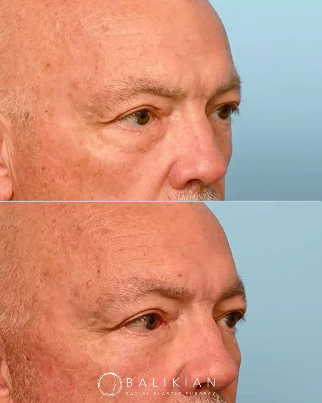 Before and after male lower blepharoplasty demonstrating reduced eye bags and refreshed lower lids.
