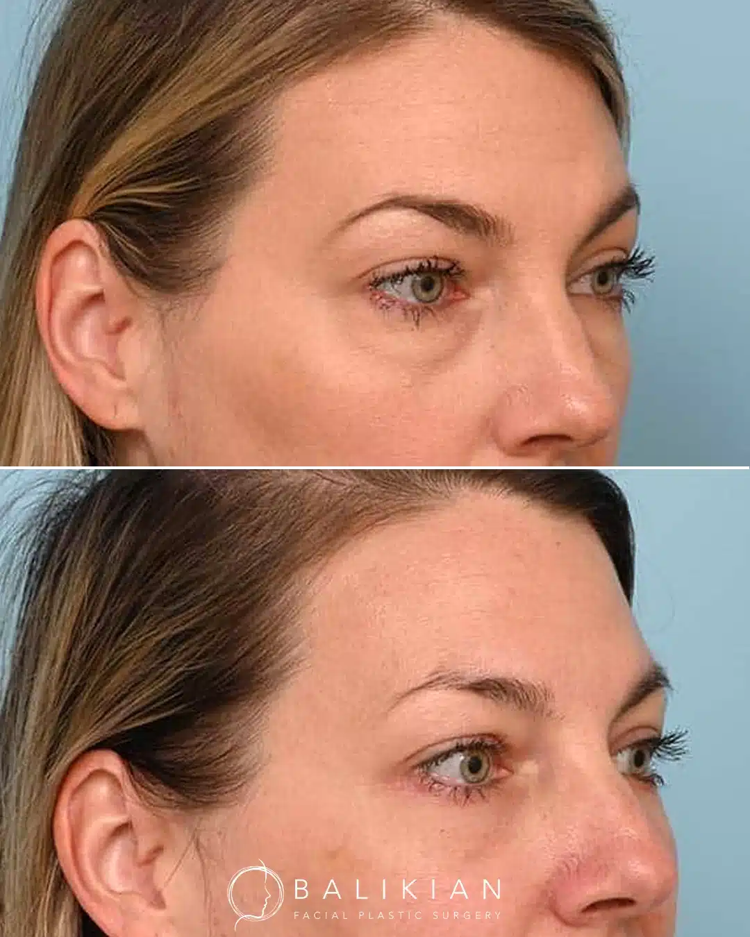 Before and after photos of a woman in her forties who underwent lower blepharoplasty, showing reduced under eye bags, smoother lower lids and a brighter, more rested appearance.