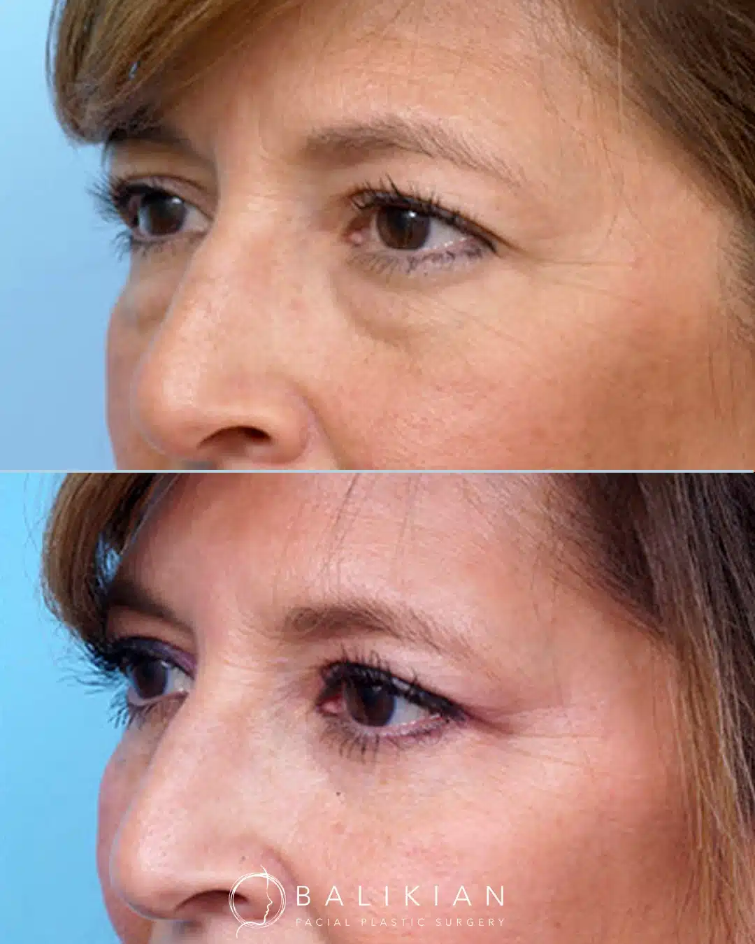 Before and after lower eyelid surgery correcting puffiness and creating a natural, rested look.