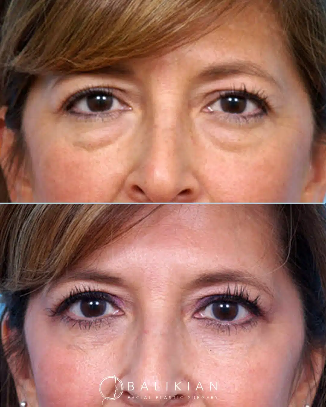 Before and after scarless lower blepharoplasty showing removal of under-eye bags and smoother lower eyelid contour.