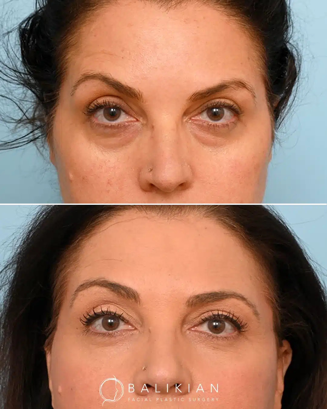 Angled before and after photos of a woman in her fifties following upper and lower eyelid surgery, showing a smoother lower lid contour and lighter, more defined upper lids.