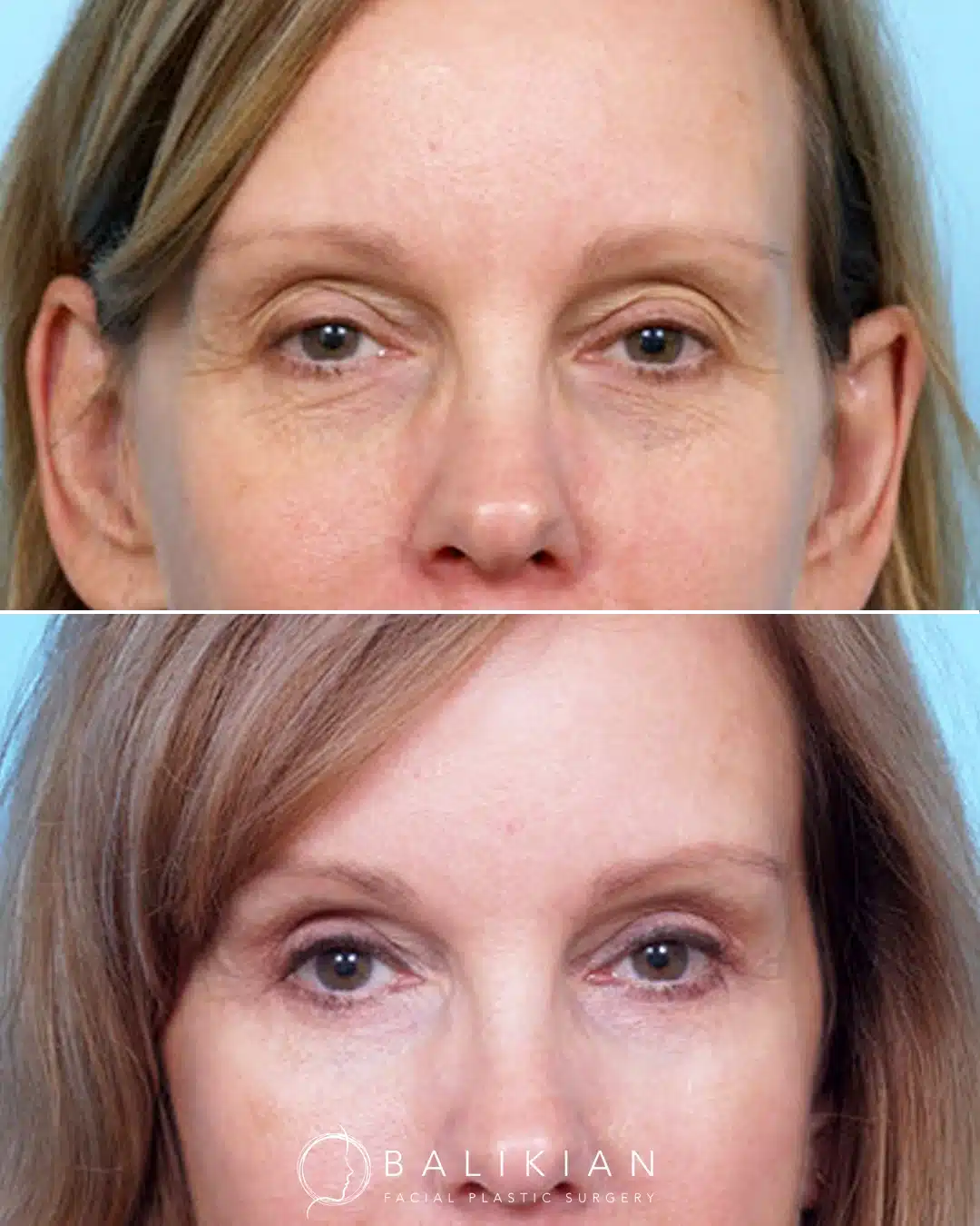 Before and after frontal photos of a woman in her forties after upper and lower eyelid surgery, demonstrating reduced puffiness, improved lid definition and a more rested overall appearance.