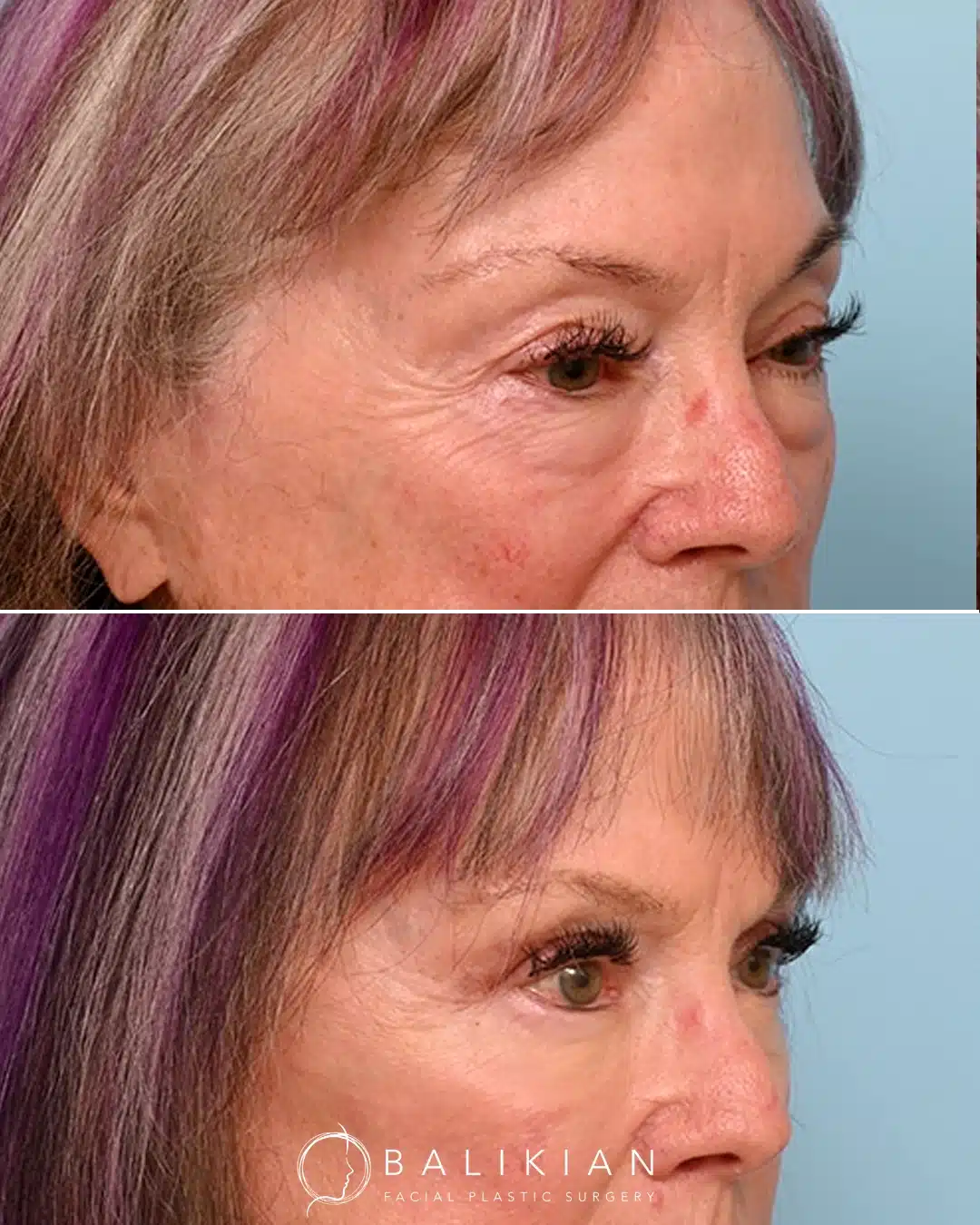 A before and after comparison of a woman in her seventies showing a smoother lower eyelid contour and reduced under eye puffiness after upper and scarless lower blepharoplasty.