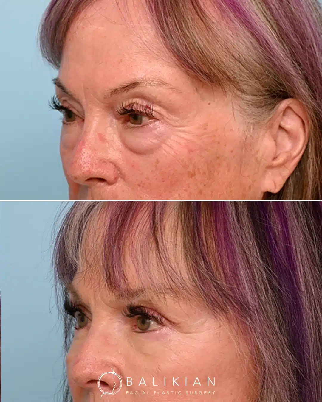 A side by side view of a woman in her seventies before and after eyelid surgery showing improvement in lower eyelid bags and a more refreshed appearance after upper and scarless lower blepharoplasty.