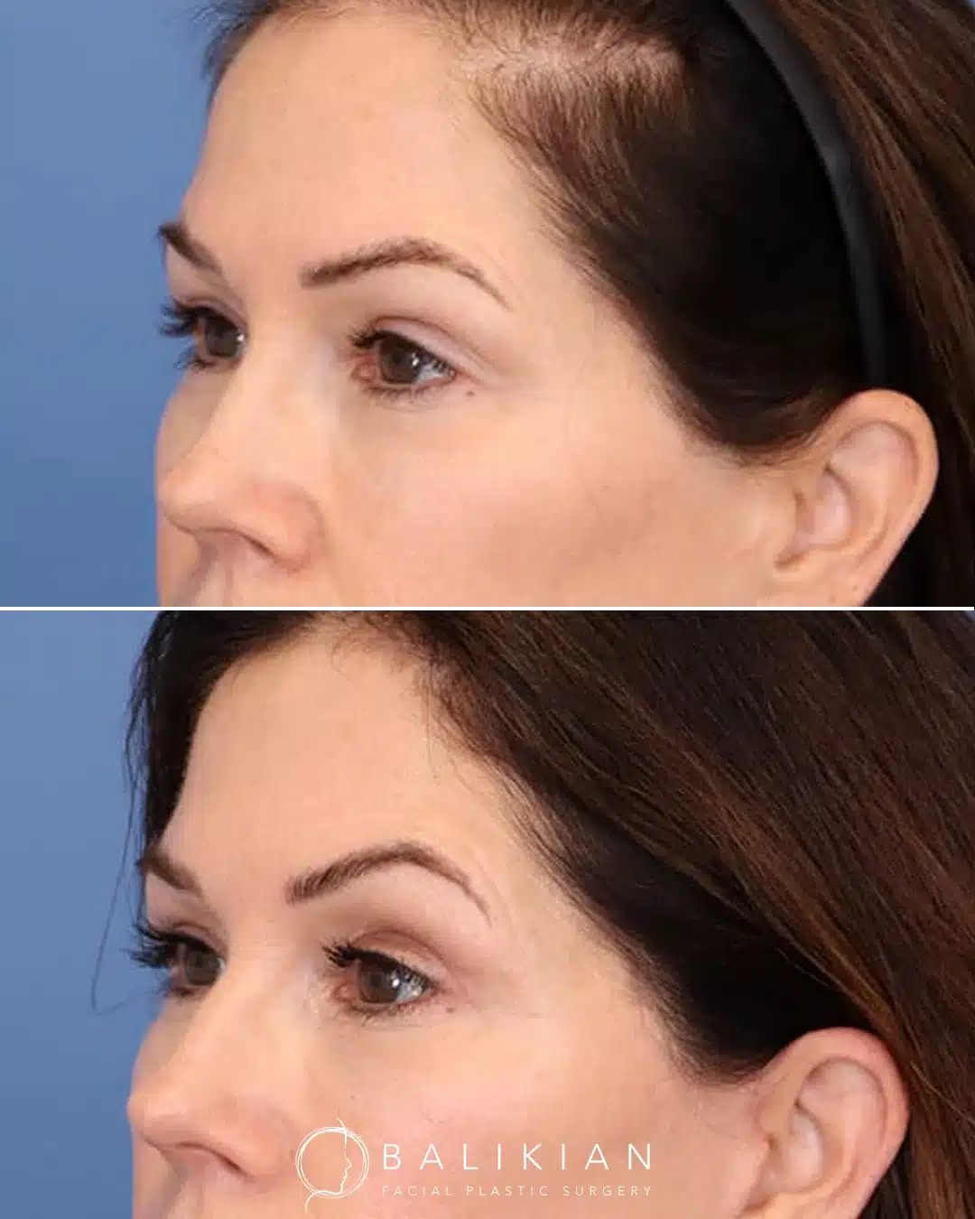 A second angled before and after comparison of a woman in her fifties showing smoother upper eyelids and a brighter eye appearance after upper blepharoplasty.