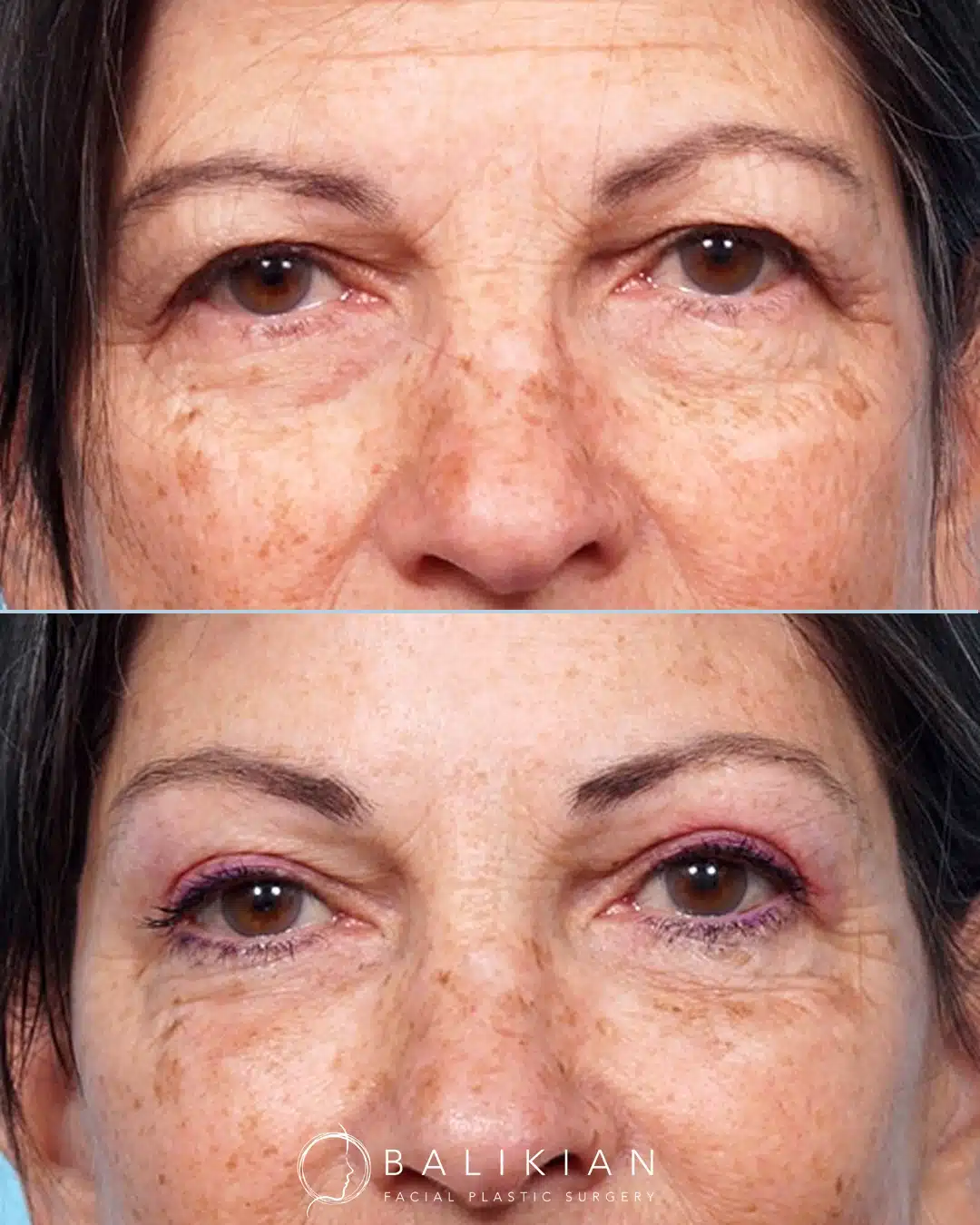 Before and after upper eyelid surgery with brow lift revealing smoother upper lids and improved eyelid contour.