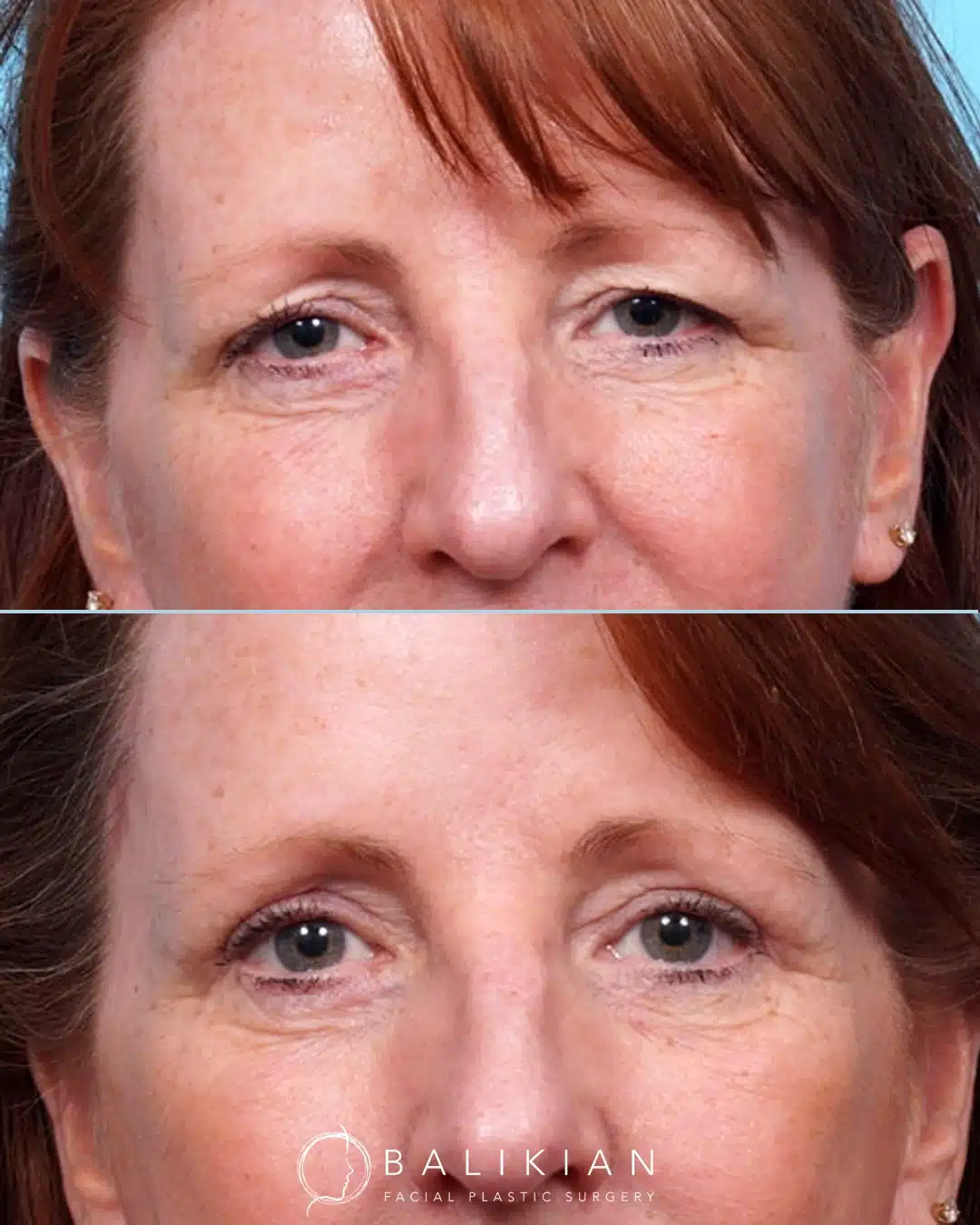 Before and after upper blepharoplasty with temporal brow lift showing correction of hooded eyelids and brighter, more open eyes.