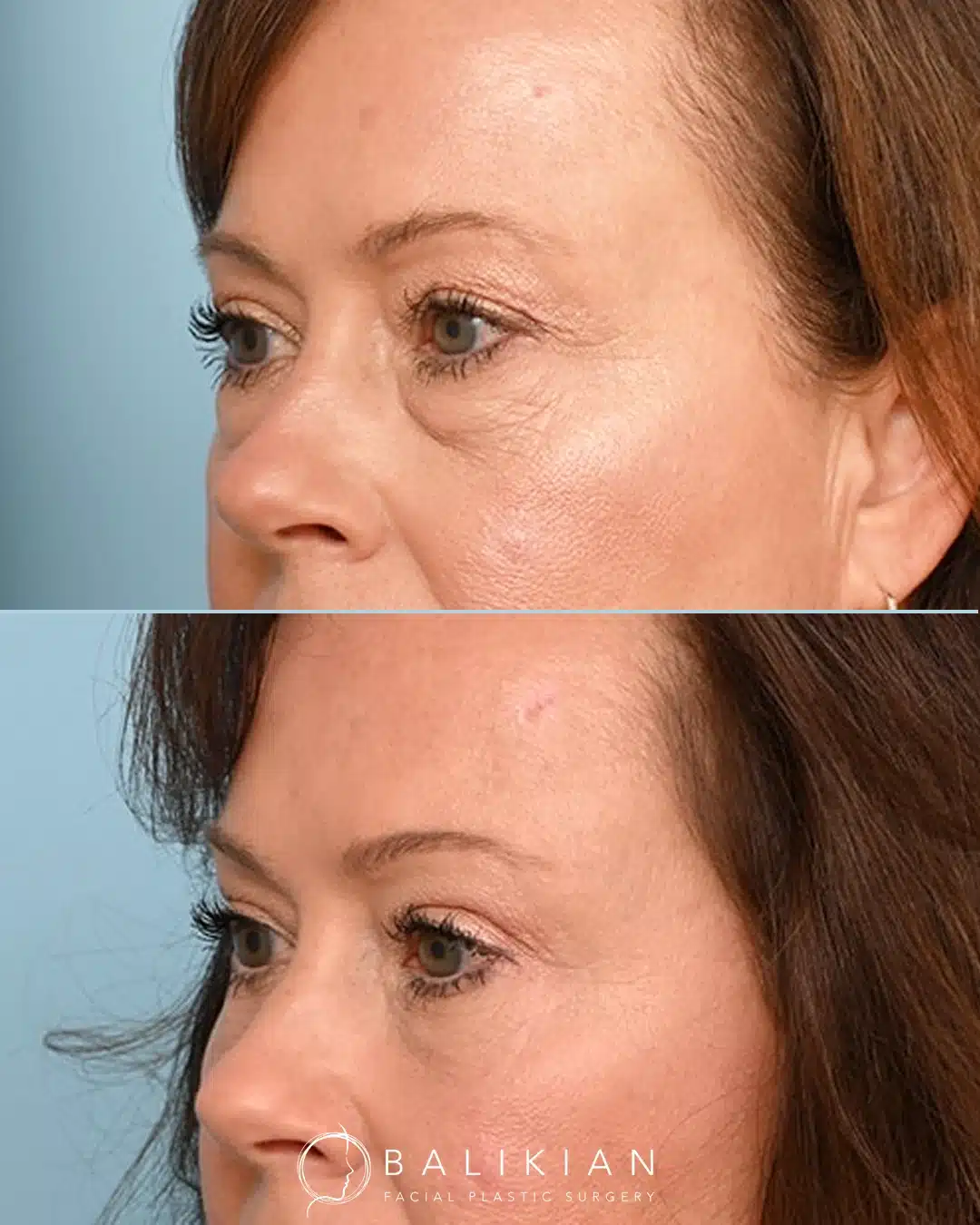 Before and after upper and lower eyelid rejuvenation with fat transfer restoring volume and reducing lower eyelid shadows.