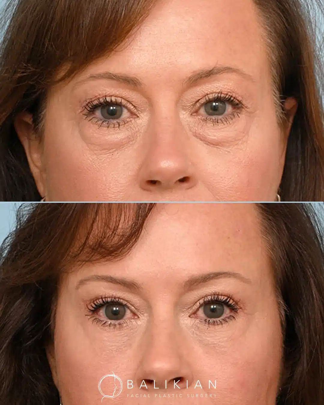Before and after eyelid surgery with fat transfer showing smoother under-eye hollows and refreshed eyelid appearance.