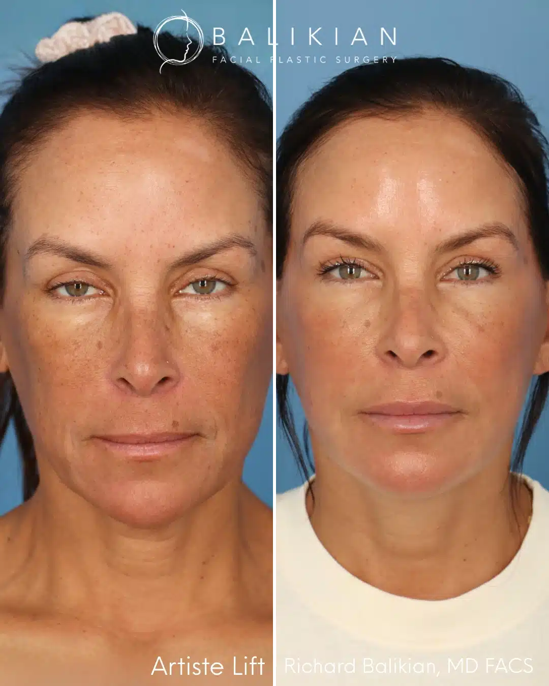 Front view before and after preservation deep plane facelift with neck lift.