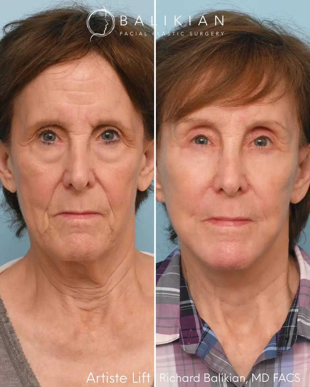Front view before and after preservation deep plane facelift with brow lift and eyelid surgery