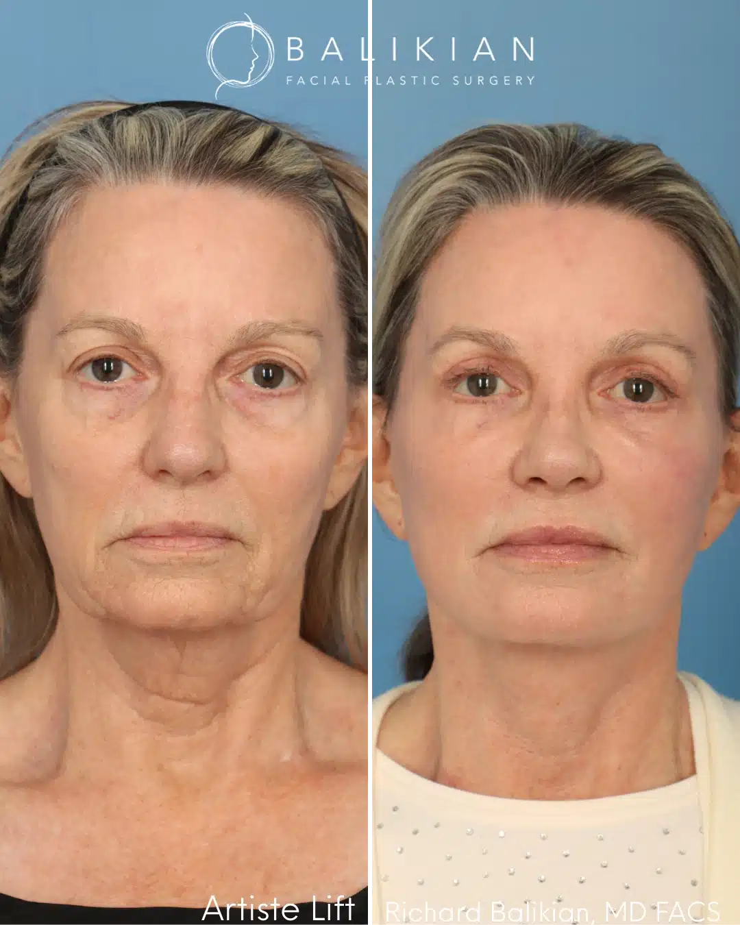 Front view before and after preservation deep plane facelift with neck lift, eyelid surgery, fat transfer, laser resurfacing, and rhinoplasty