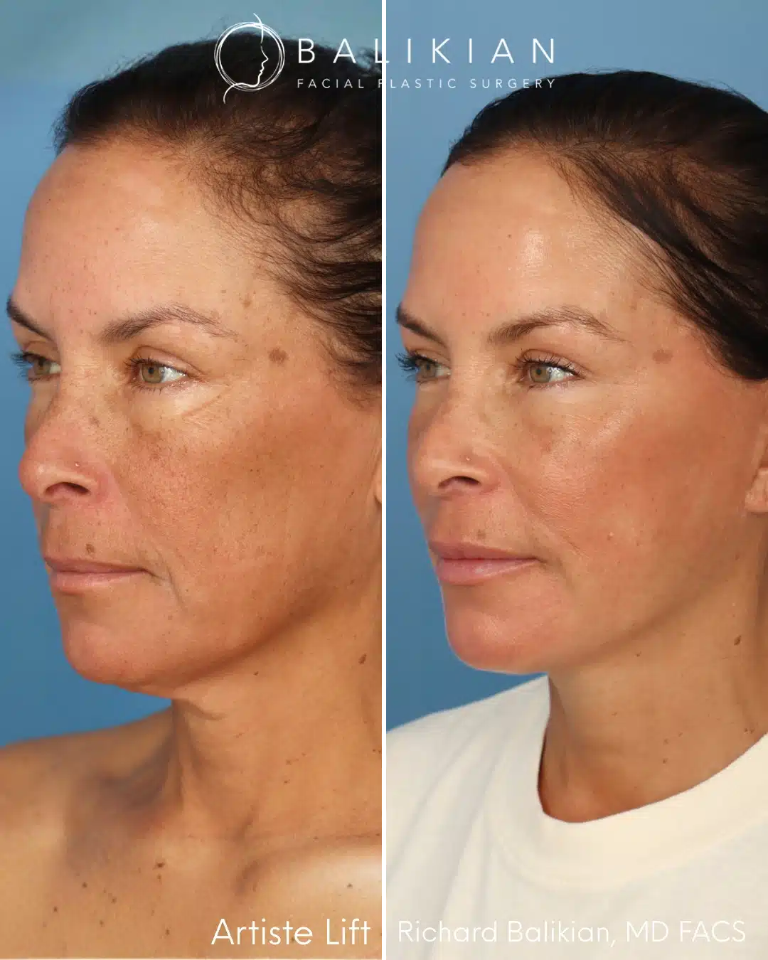 Left oblique before and after facial rejuvenation.