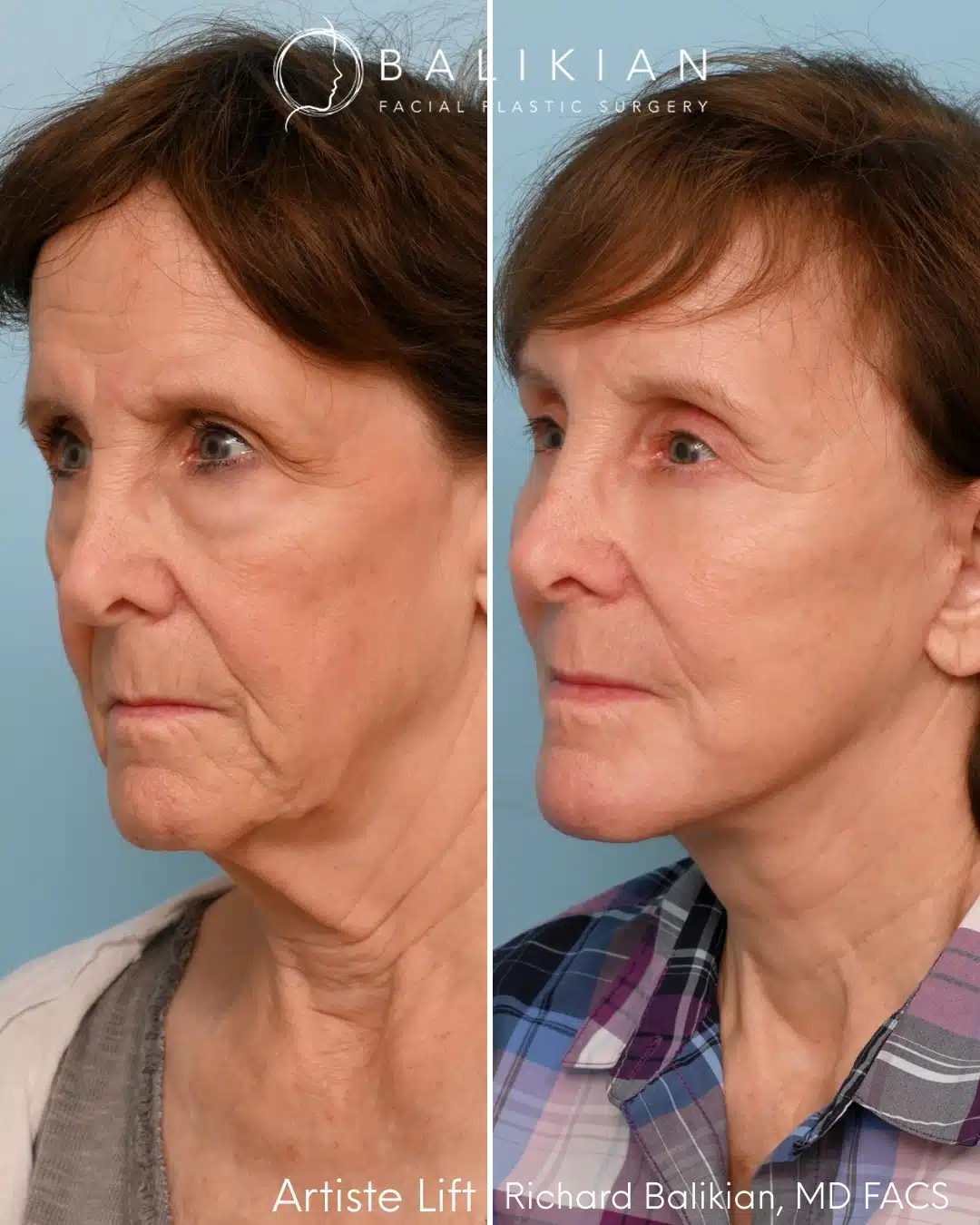 Left oblique before and after comprehensive facial rejuvenation