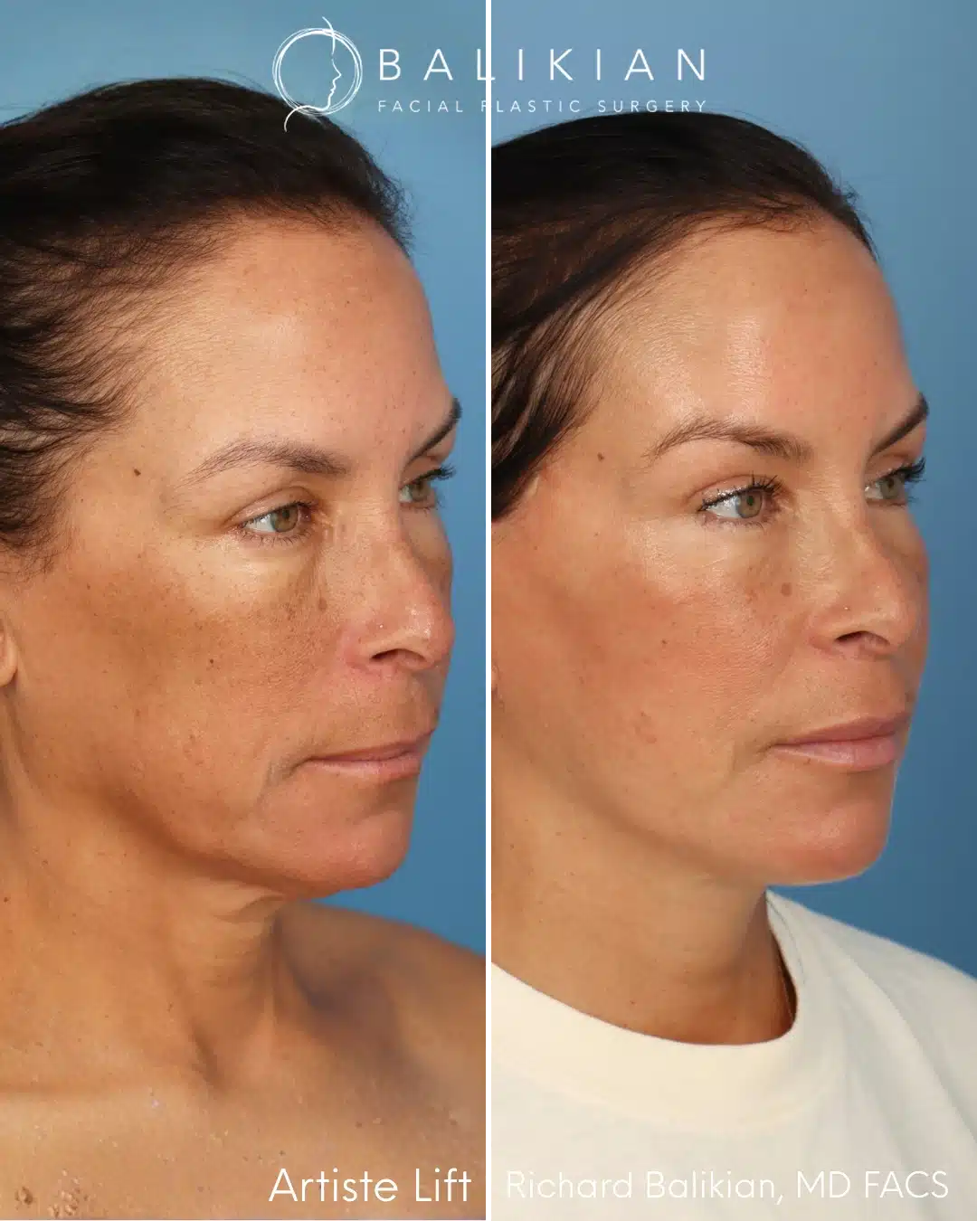 Right oblique before and after facelift with fat transfer.