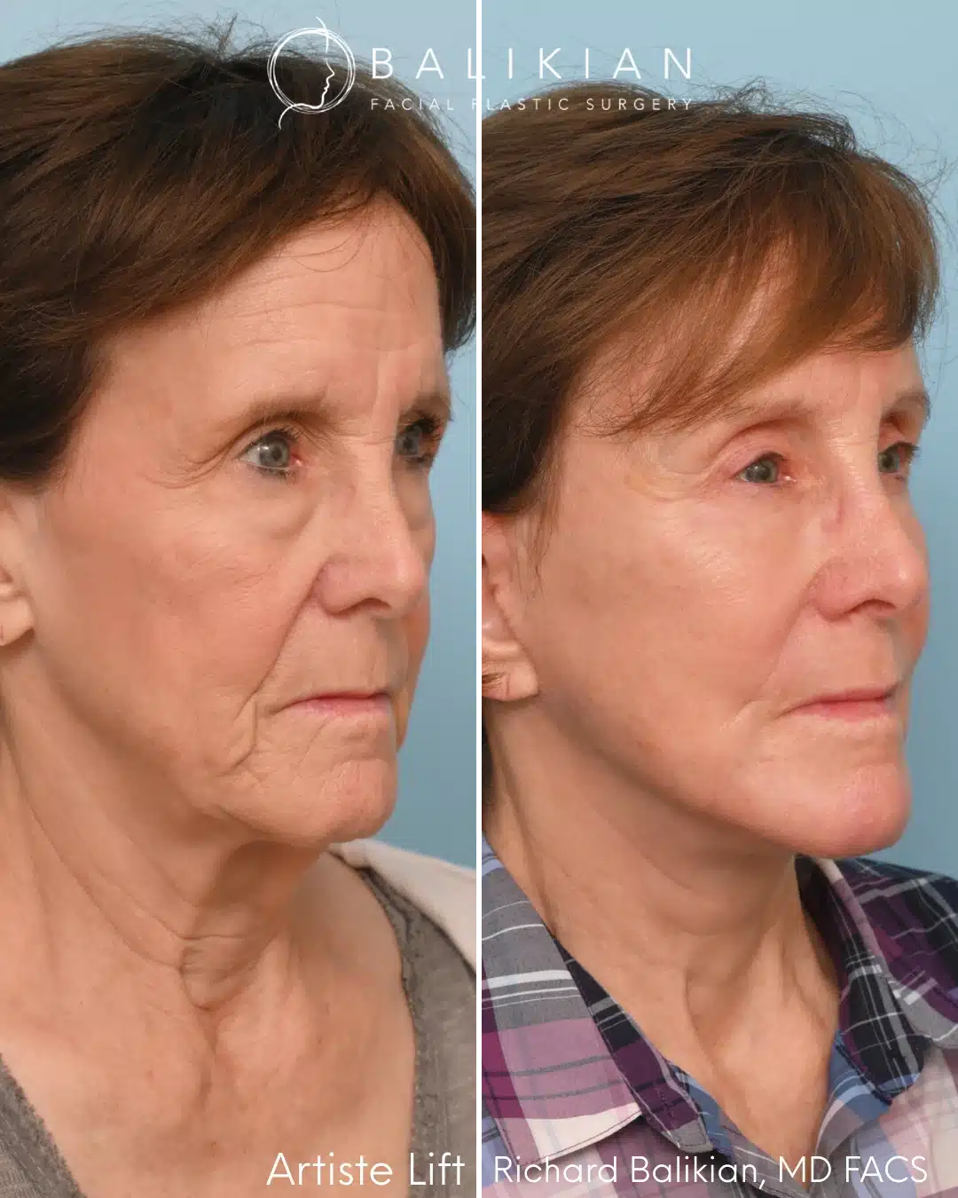 Right oblique before and after facelift with brow lift and eyelid surgery