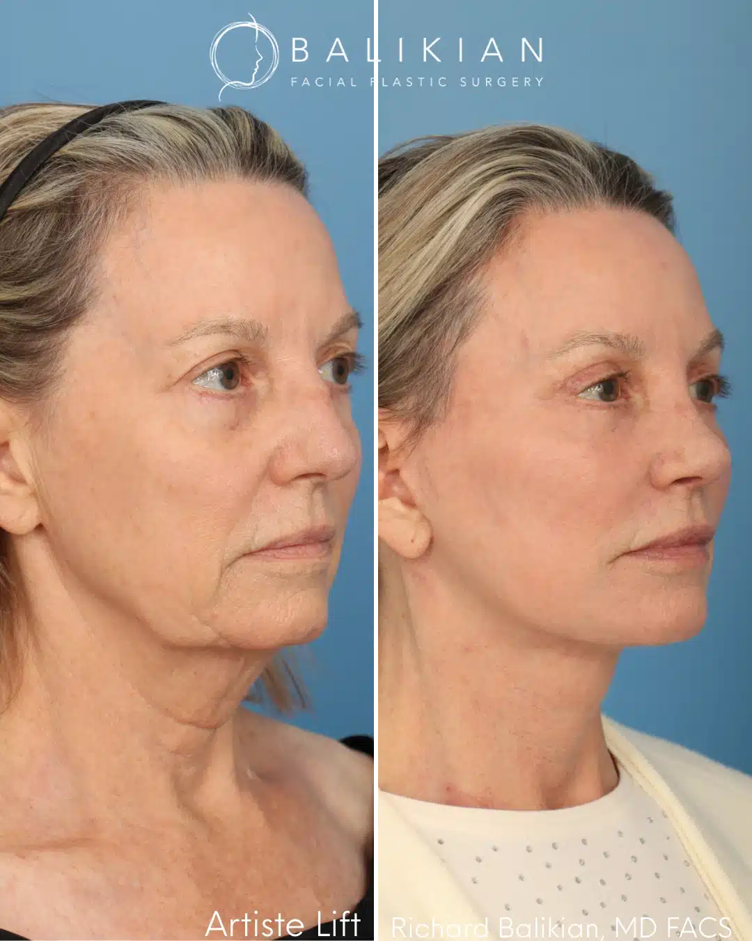 Right oblique before and after facelift with eyelid surgery and fat transfer
