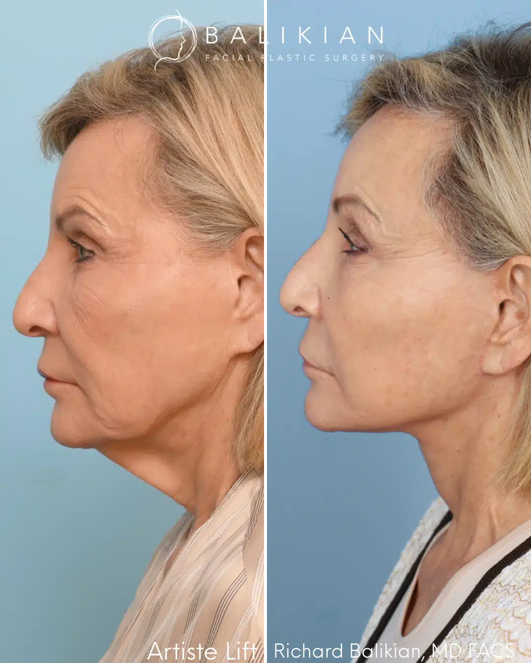 Left profile before and after showing improved neck contour and facial support following deep plane facelift surgery.