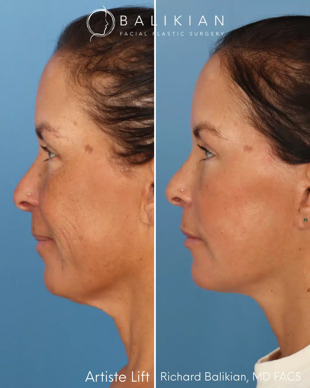 Left profile before and after facial rejuvenation surgery.