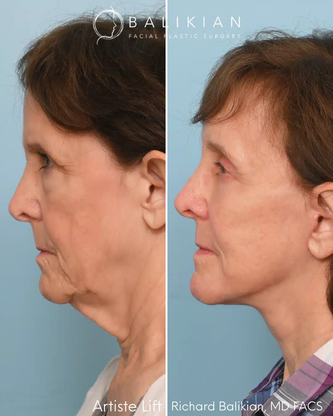 Left profile before and after facial rejuvenation surgery