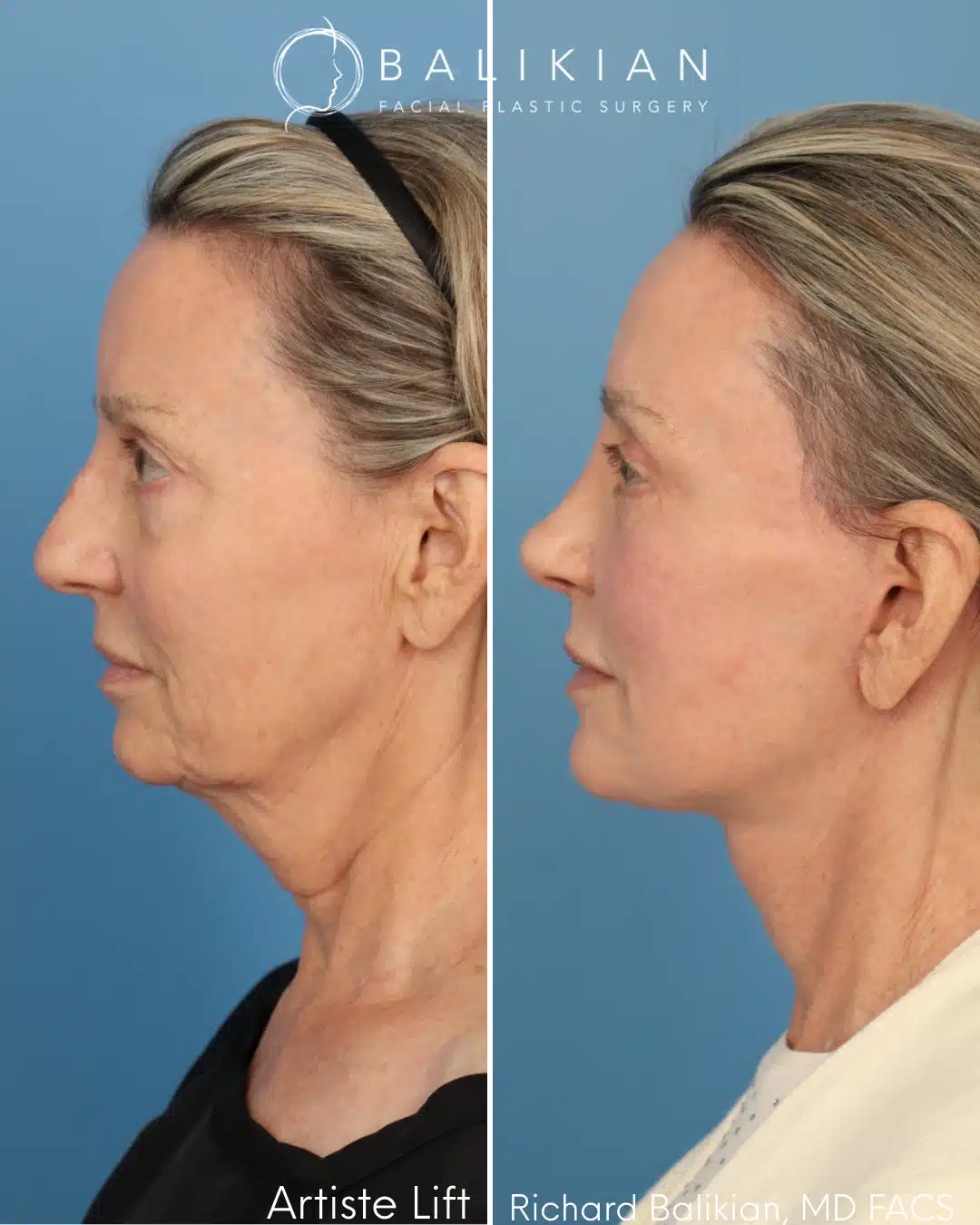 Left profile before and after facial rejuvenation surgery with neck lift