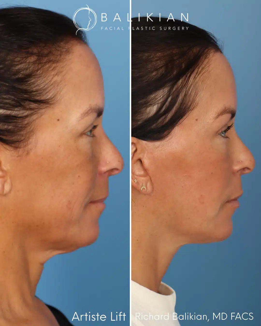 Right profile before and after deep plane facelift and neck lift.