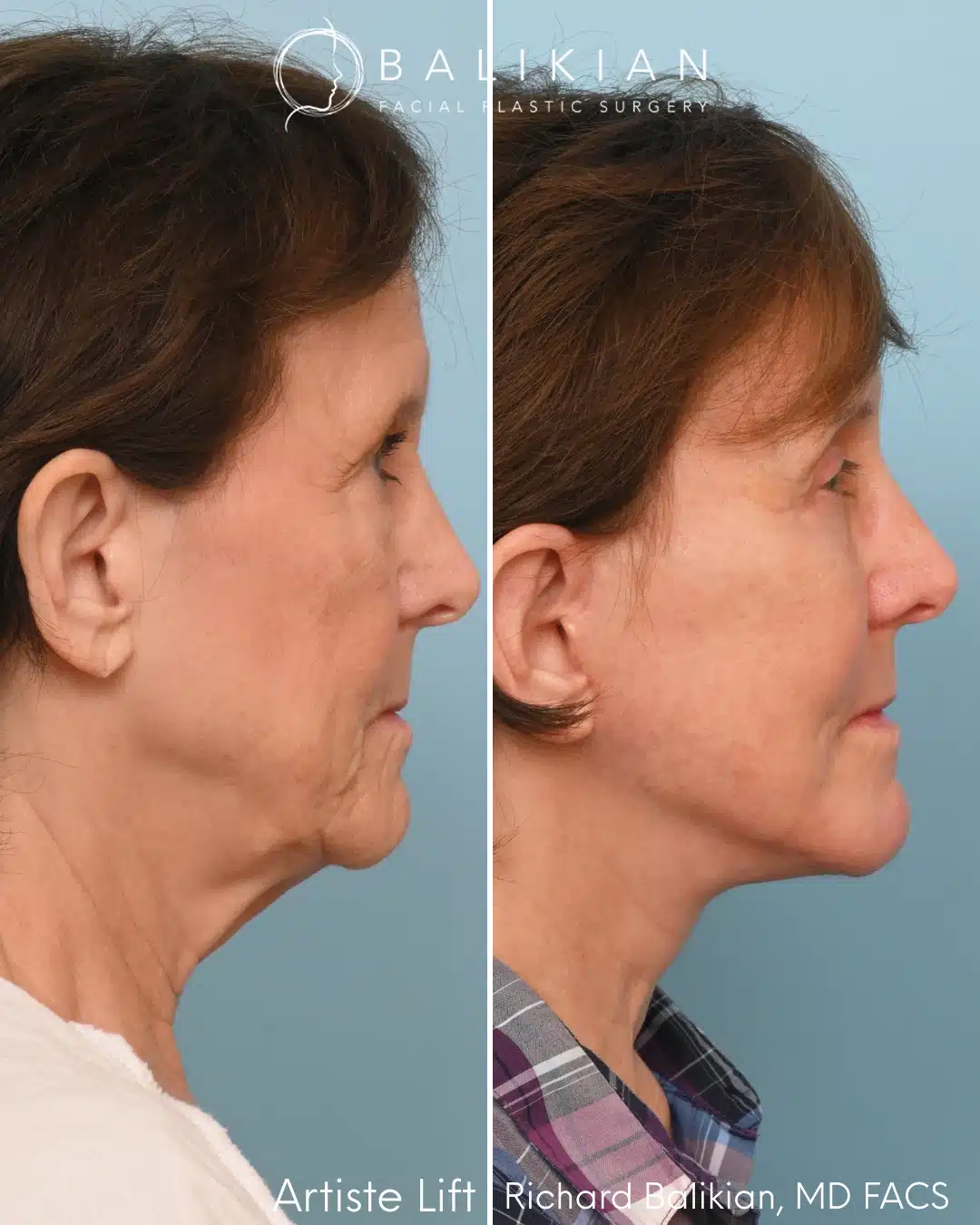 Right profile before and after deep plane facelift with neck lift