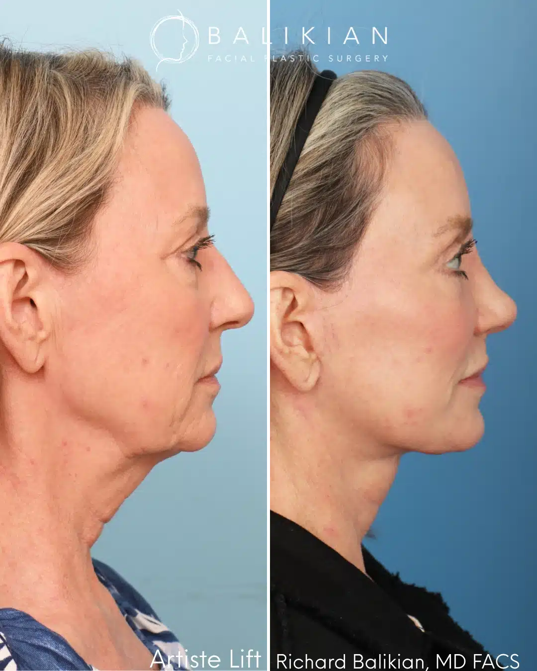 Right profile before and after deep plane facelift and neck lift.