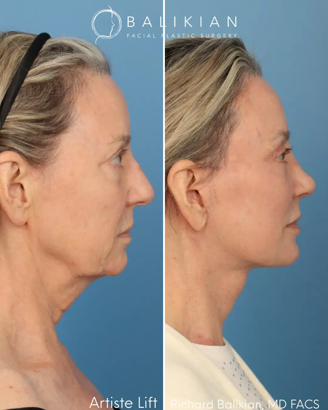 Right profile before and after deep plane facelift with neck lift and rhinoplasty