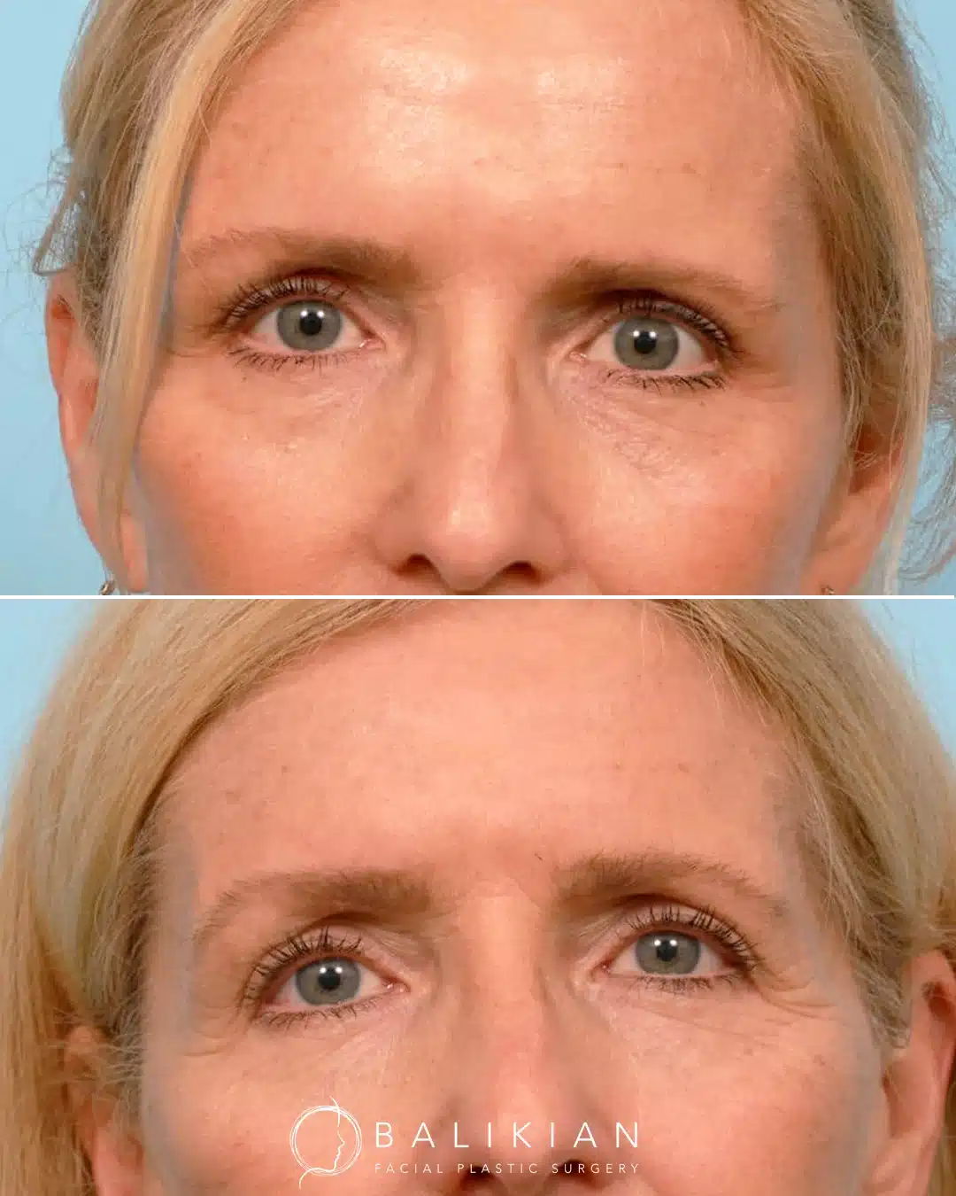 Before and after front view showing upper blepharoplasty with facelift and temporal brow lift, improving eyelid contour and outer eyelid skin.