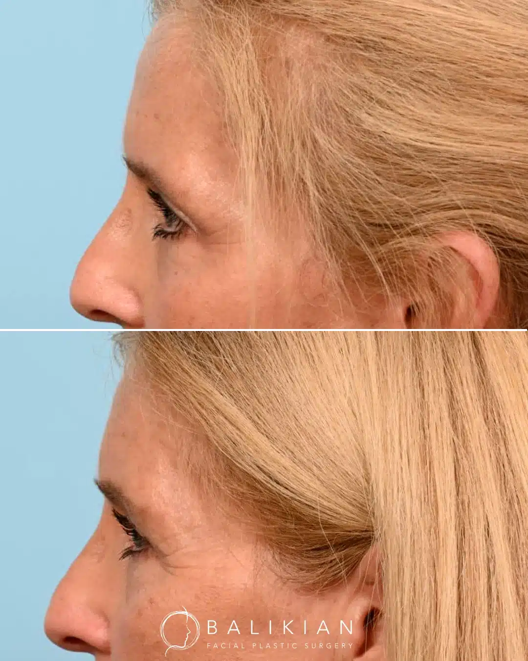 Before and after side view highlighting upper blepharoplasty with facelift and temporal brow lift, showing smoother eyelid and brow transition.