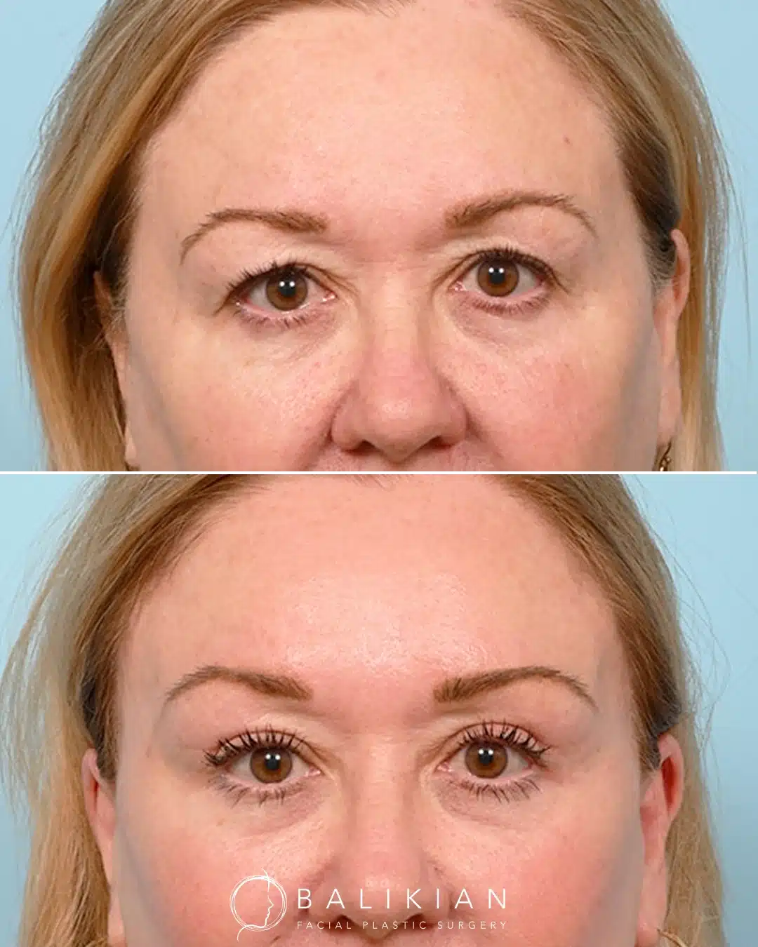 Before and after front view of upper blepharoplasty with facelift and temporal brow lift, showing brighter and more open-looking eyes.