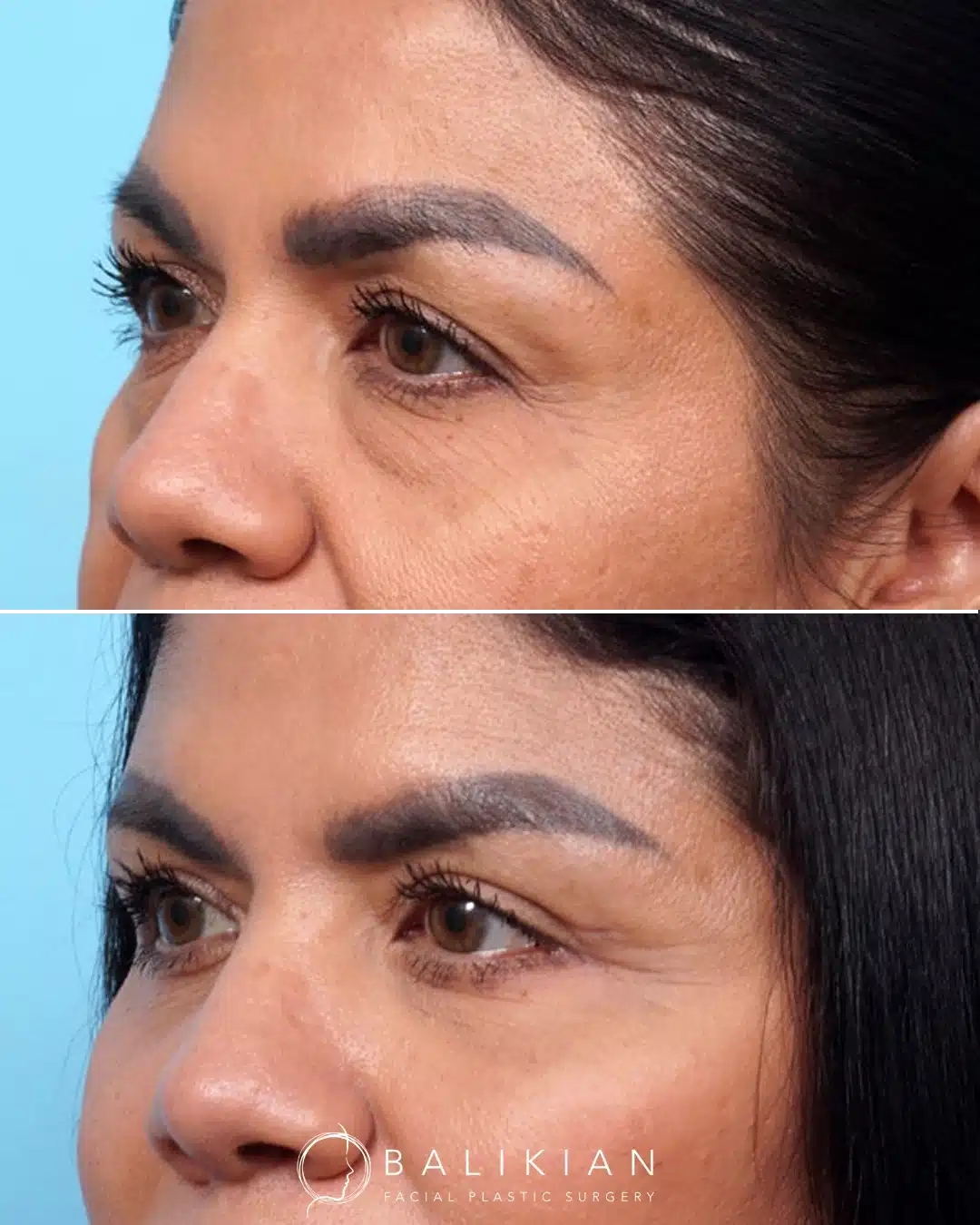 Before and after oblique view showing upper and lower blepharoplasty with facial fat transfer and facelift, improving eyelids and cheek transition.