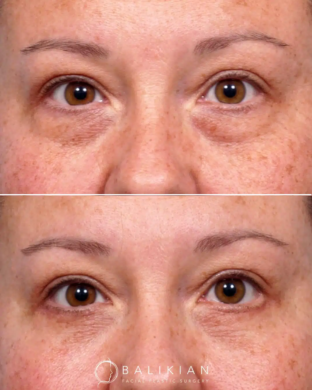 Before and after front view of lower blepharoplasty, showing reduced under-eye bags and smoother lower eyelids.