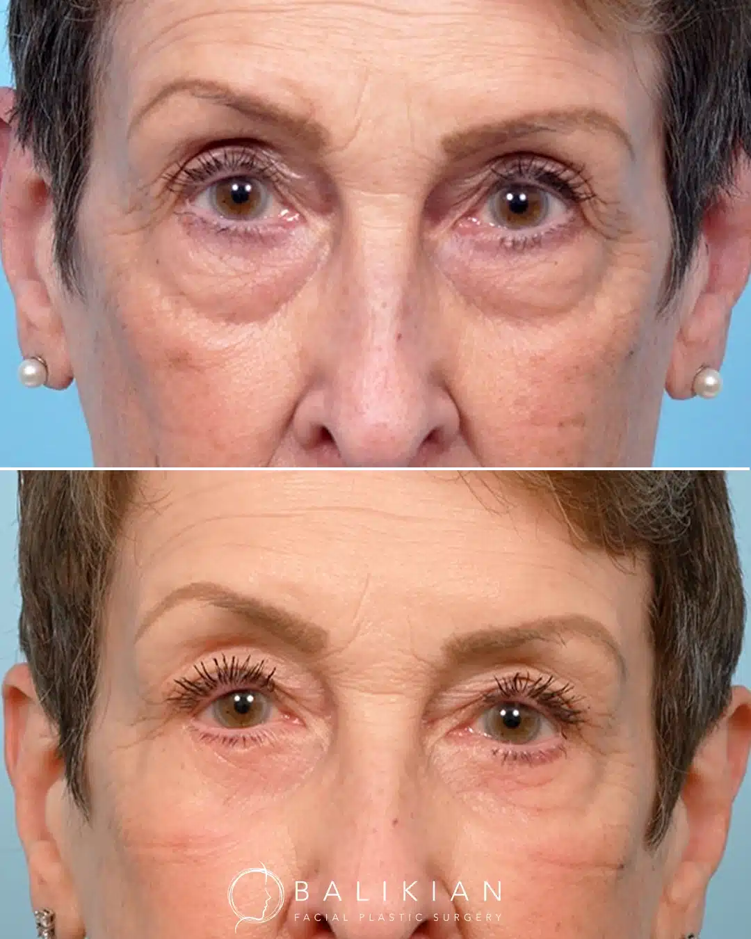 Before and after front view showing lower blepharoplasty for correction of under-eye bags and eyelid fullness.