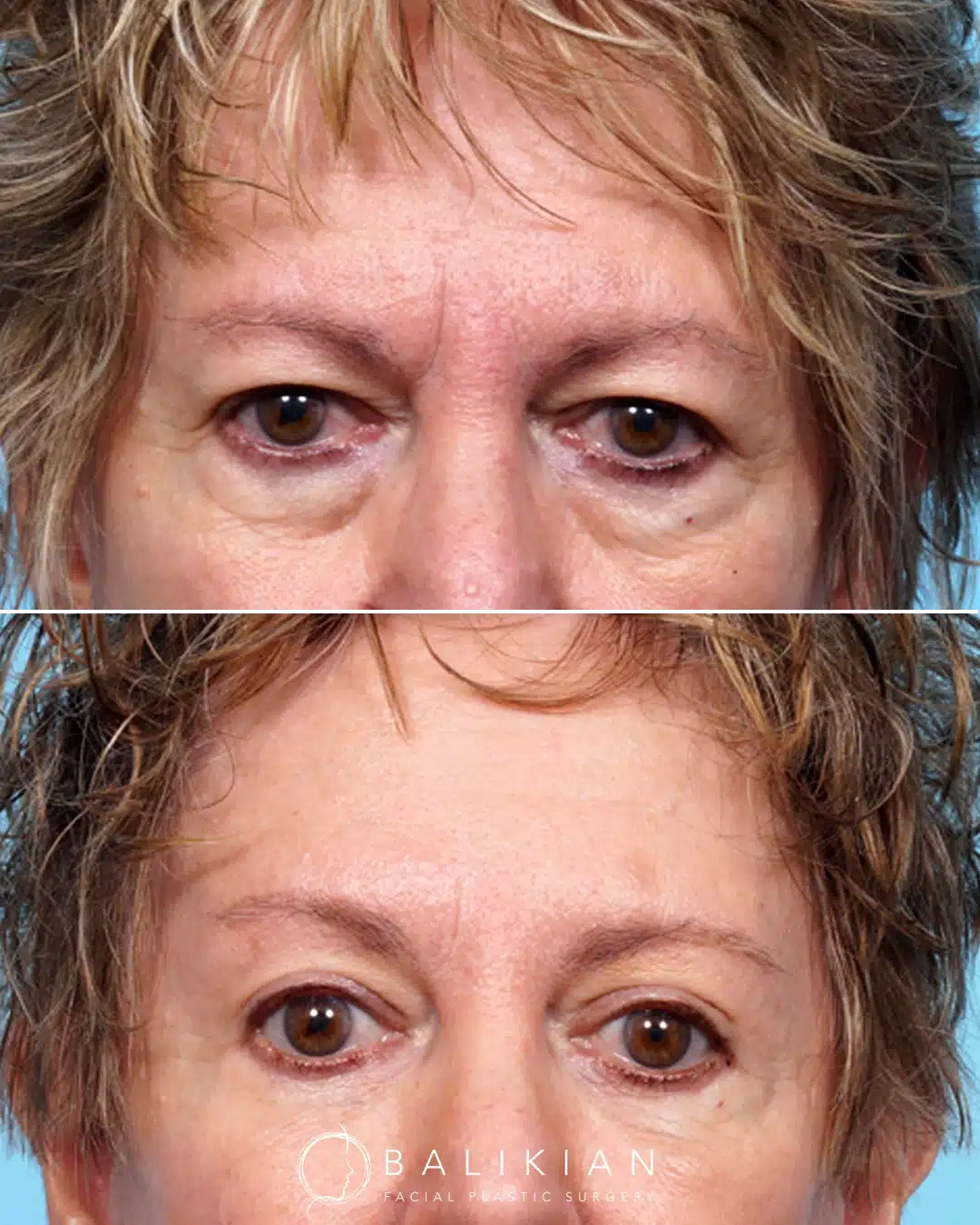 Before and after front view showing quad blepharoplasty with facelift, brow lift, and facial fat transfer improving eyelids and overall facial balance.