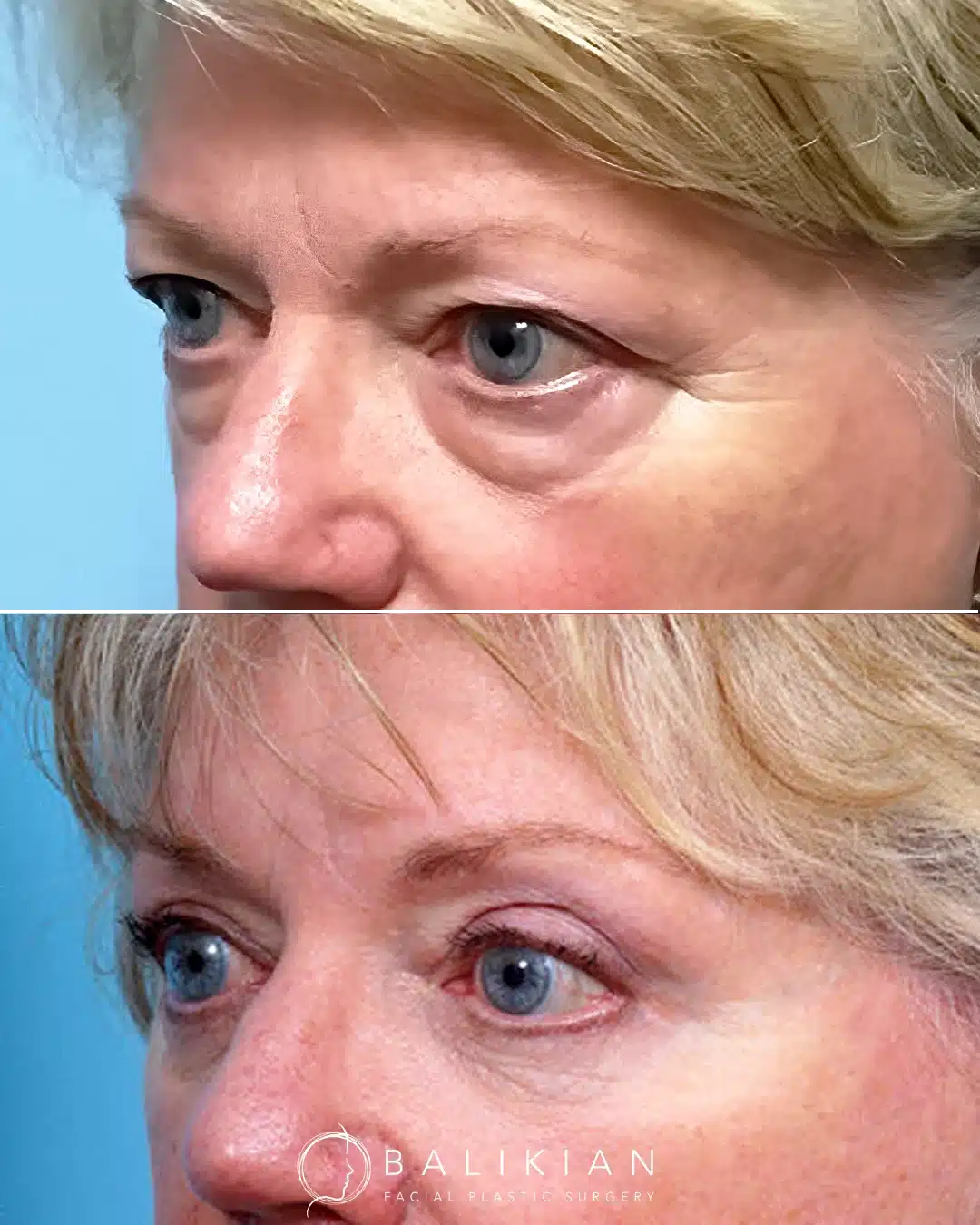 Before and after oblique view of quad blepharoplasty showing upper and lower eyelid lift with smoother eyelid contours.