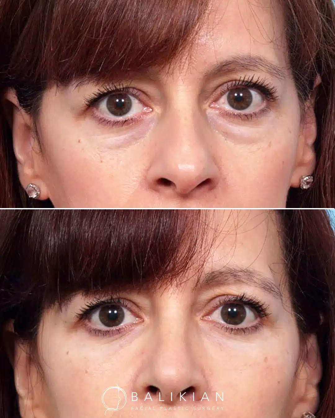 Before and after front view showing transconjunctival lower blepharoplasty with fat transfer and rhinoplasty, improving under-eye contour.
