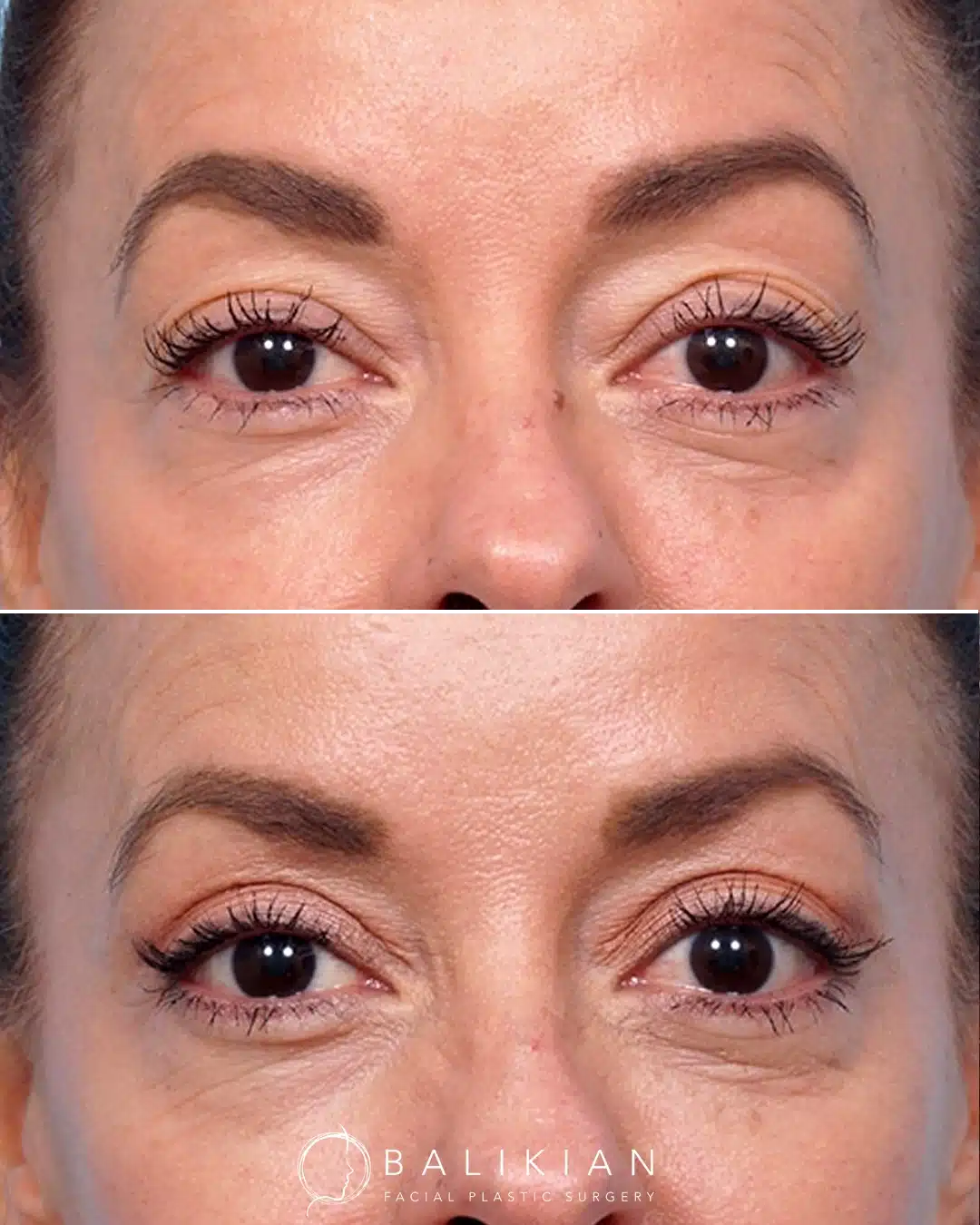 Before and after front view of upper eyelid blepharoplasty correcting excess eyelid skin.