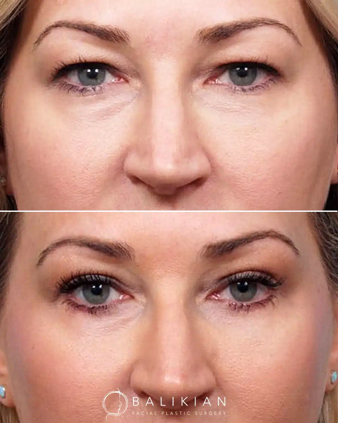 Before and after front view of upper and lower blepharoplasty improving eyelid definition.