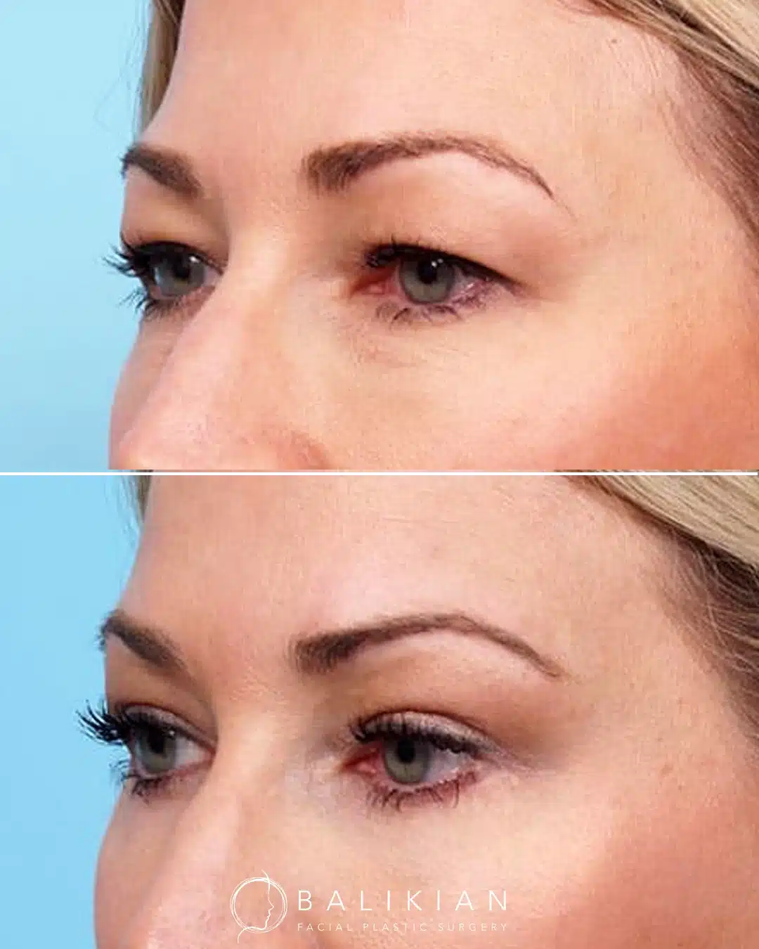 Before and after oblique view of upper and lower blepharoplasty showing improved eyelid contour.