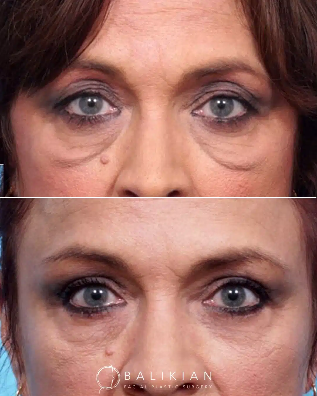 Before and after front view of upper and lower blepharoplasty combined with facelift showing refreshed eyes and smoother lower eyelids.