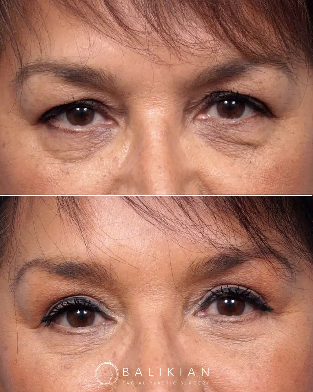 Before and after front view of upper and lower blepharoplasty reducing eyelid heaviness and under eye fullness.